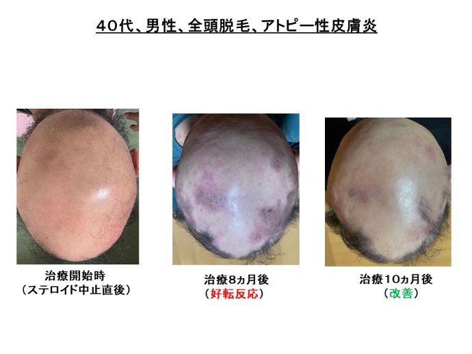 円形脱毛症　病院